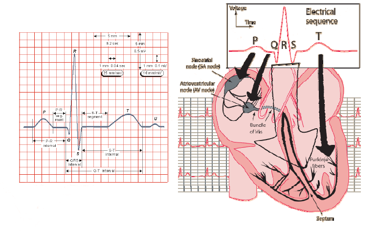 Ηλεκτροκαρδιογράφημα (ECG) Τυπικό