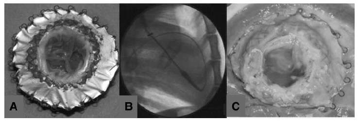 ΑΝΣΙΜΕΣΩΠΙΗ Boudjemline Y, et al.