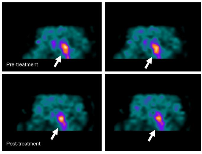 n=12 Πξν-κεηά Etanercept Spect Scan Καηάζιηςε ζε ΦΑ: Όρη κόλν