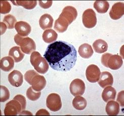 Natural killer cells (NK cells) Type of large granular lymphocyte (LGL) or null cell