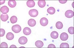 Platelets Megakaryocytic fragments in blood