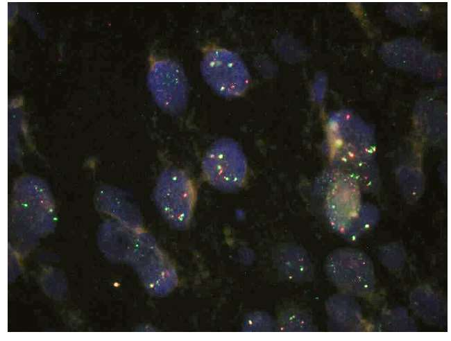 ΚΠΚ με ALK+ ~ 1,4 εως 2,5% επιπολασμό -Anaplastic lymphoma kinase-positive squamous cell carcinoma of the lung: A case report. Yamamoto Y, Kodama K, Maniwa T, Takeda M, Kishima H. Mol Clin Oncol.