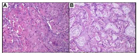 ΑΔΕΝΟΠΛΑΚΩΔΕΣ ΚΑΡΚΙΝΩΜΑ Jamie E. Chaft, MD, J Thorac Oncol. 2012 April ; 7(4): 768 769.