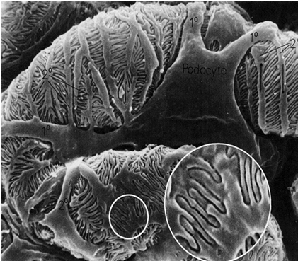 Η παθοφυσιολογία του ανθρώπινου νεφρού Εικόνα 11 Ποδοκύτταρα και φραγμός διήθησης. Φωτογραφίες από μικροσκοπία SEM.