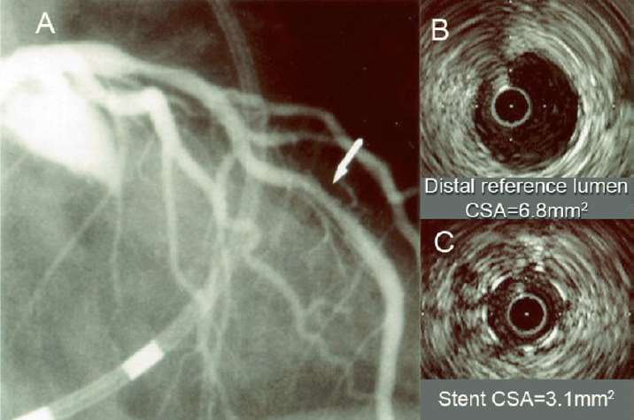 stent In-Stent