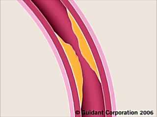 Τοποθέτηση του stent Πρόκληση αγγειακού τραύματος υπερδιάτασης ( overstretch injury ) Αλληλεπίδραση αγγειακού τοιχώματος, αίματος και μεταλλικού πλέγματος (υλικό, υφή) αντιδράσεις υπερευαισθησίας,