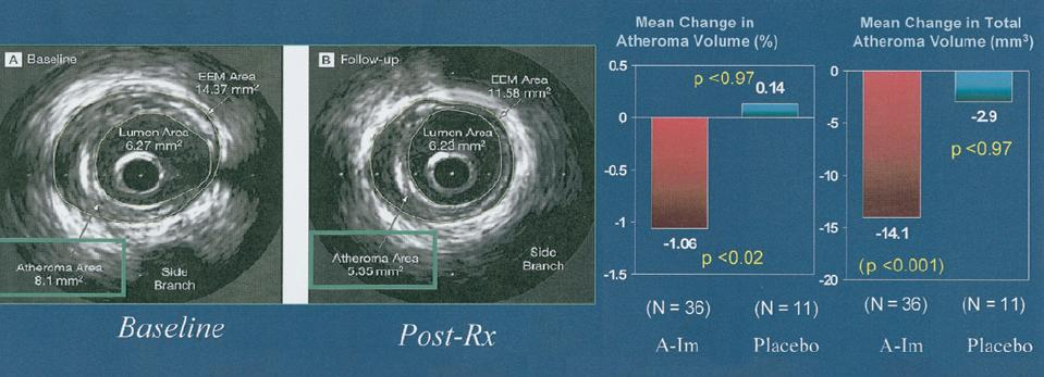 IVUS images of coronary plaque before and 5 weeks after once weekly intravenous injection of