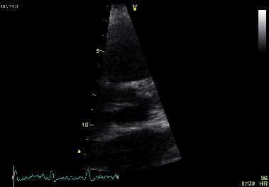 Bicuspid