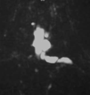 Στεφανιαία εκόνα μαγνητικής τομογραφίας Τ2-w με συμπίεση του σήματος του λίπους αναδεικνύει συλλογή υγρού στο αριστερό Α7-Θ1 μεσοσπονδύλιο τρήμα με επέκταση στα μαλακά μόρια του κατώτερου αυχένα που