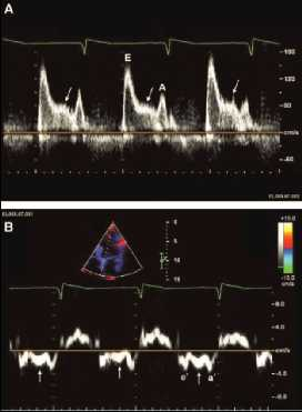 1) An L-wave is very often an unnoticed finding. 2) The L-wave may be seen in relatively bradycardic patients with normal hearts.