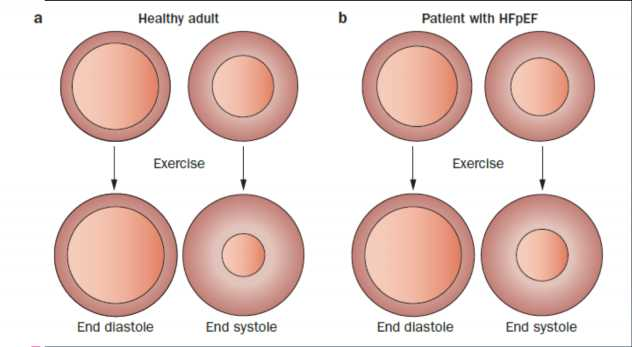 LV systolic limitations However, with exercise stress, the increase in ejection fraction is blunted in the patient with HFpEF owing to the inability to contract to as low an end-systolic volume,