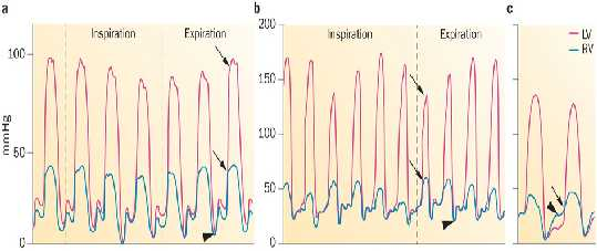 confirmed by MRI or CT (2) restrictive Doppler findings of transmitral and/or pulmonary venous flow velocity patterns and