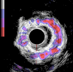 Τεχνική ανίχνευσης περιοχών εκφύλισης των τοιχωμάτων αρτηριών με ενδαγγειακούς Υπερήχους.