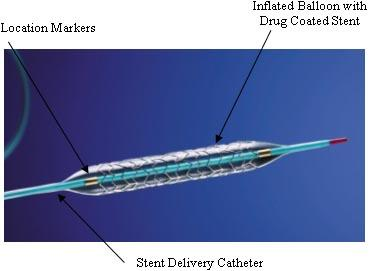 1.3 Stent Το στεφανιαίο stent είναι ένας σωλήνας (νάρθηκας) που τοποθετείται στις στεφανιαίες αρτηρίες οι οποίες τροφοδοτούν την καρδιά ώστε να κρατούν τις αρτηρίες ανοικτές κατά τη θεραπεία των