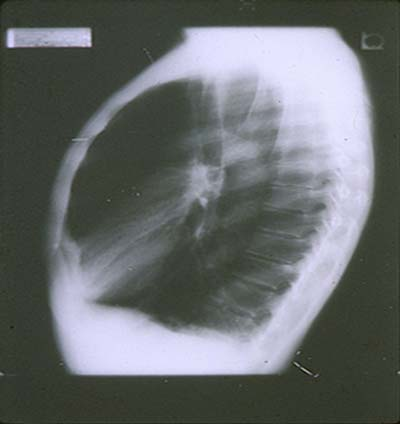 Reduced expiratory flow