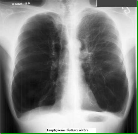 alveoli, and short