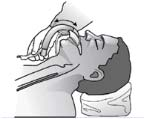 2. Τοποθετήστε την κεφαλή σε ουδέτερη θέση, βάζοντας ένα μαξιλάρι κάτω από την κεφαλή. Μην εκτείνετε την κεφαλή. 3.