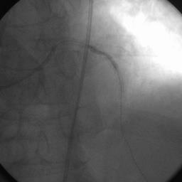 Rotablation- PCI LAD Rotawire