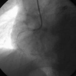 Rotablation-PCI RCA Cutting balloon