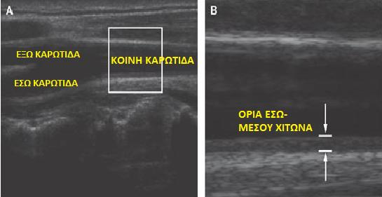 Εικόνα 7. Απεικόνιση με B-mode υπερηχογράφημα της καρωτίδας αρτηρίας (Α) και των ορίων του έσω-μέσου χιτώνα (Β). 2.