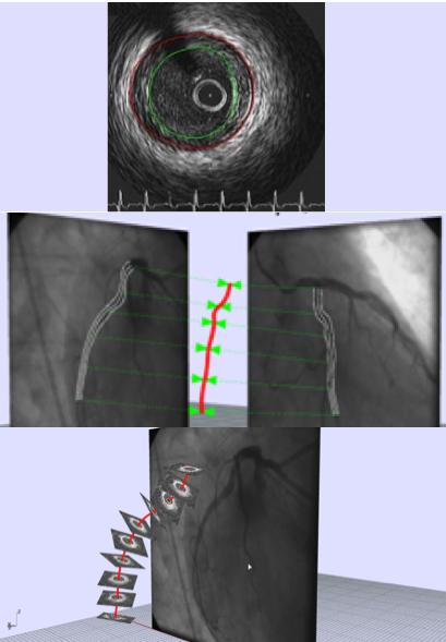 το εργαλείο επέτρεψε την ακριβή τρισδιάστατη ανακατασκευή της διαδροµής του καθετήρα και του αγγείου, µέσα από τις προσλαµβανόµενες εικόνες της στεφανιογραφίας και την τοποθέτηση των εικόνων IVUS