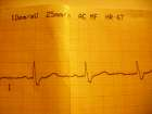 SR-RBBB