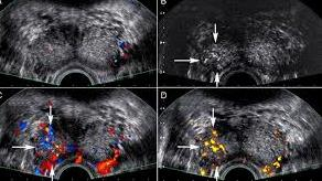 Power Doppler TRUS ένδειξη για βιοψία