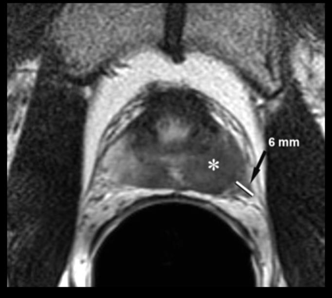 MRI Μεγαλύτερη ανάλυση από τον διορθικό υπέρηχο.