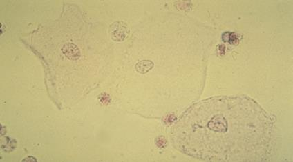 Επιθηλιακά Κύτταρα Από εγγύς εσπειραμένα έως ουρήθρα