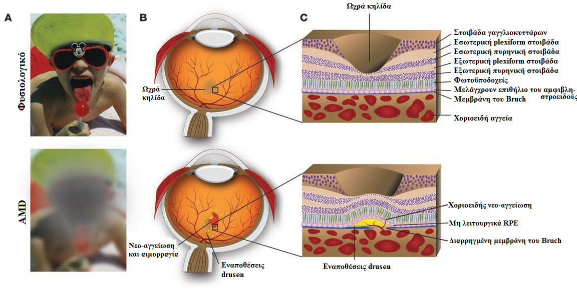 εξίδρωση υγρών, εναπόθεση λιπιδίων, αποκόλληση του RPE από το χοριοειδές, ινώδεις ουλές ή ένα συνδυασµό όλων αυτών των ευρηµάτων (de Jong P.T., 2006). Εικόνα 3.
