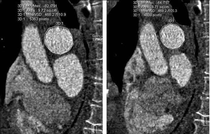 ημεία πνεσμονικής σπέρηαζης MDCTPA Decrease in right pulmonary artery distensibility Revel MP et al.