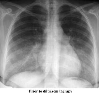 HRCT is the investigation of choice Galie N, Hoeper MM, Humbert M, et al.