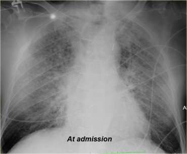 interstitial edema with