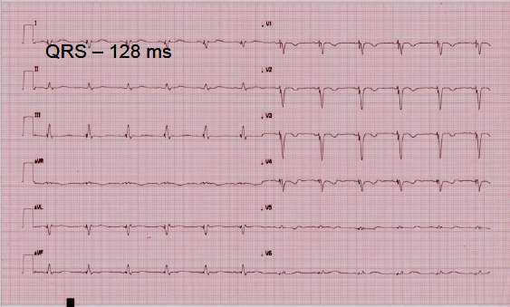 Περιστατικό 2 Heart failure NYHA I (σημαντική βελτίωση) HR