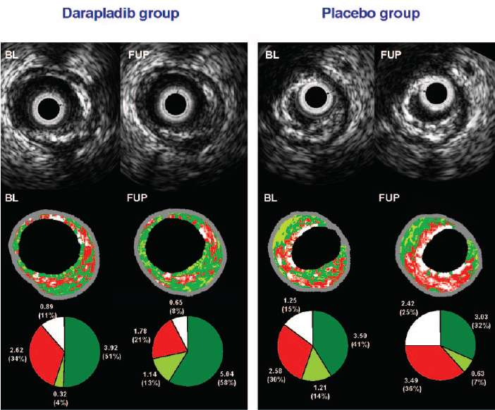 Effects of Darapladib on Coronary plaque