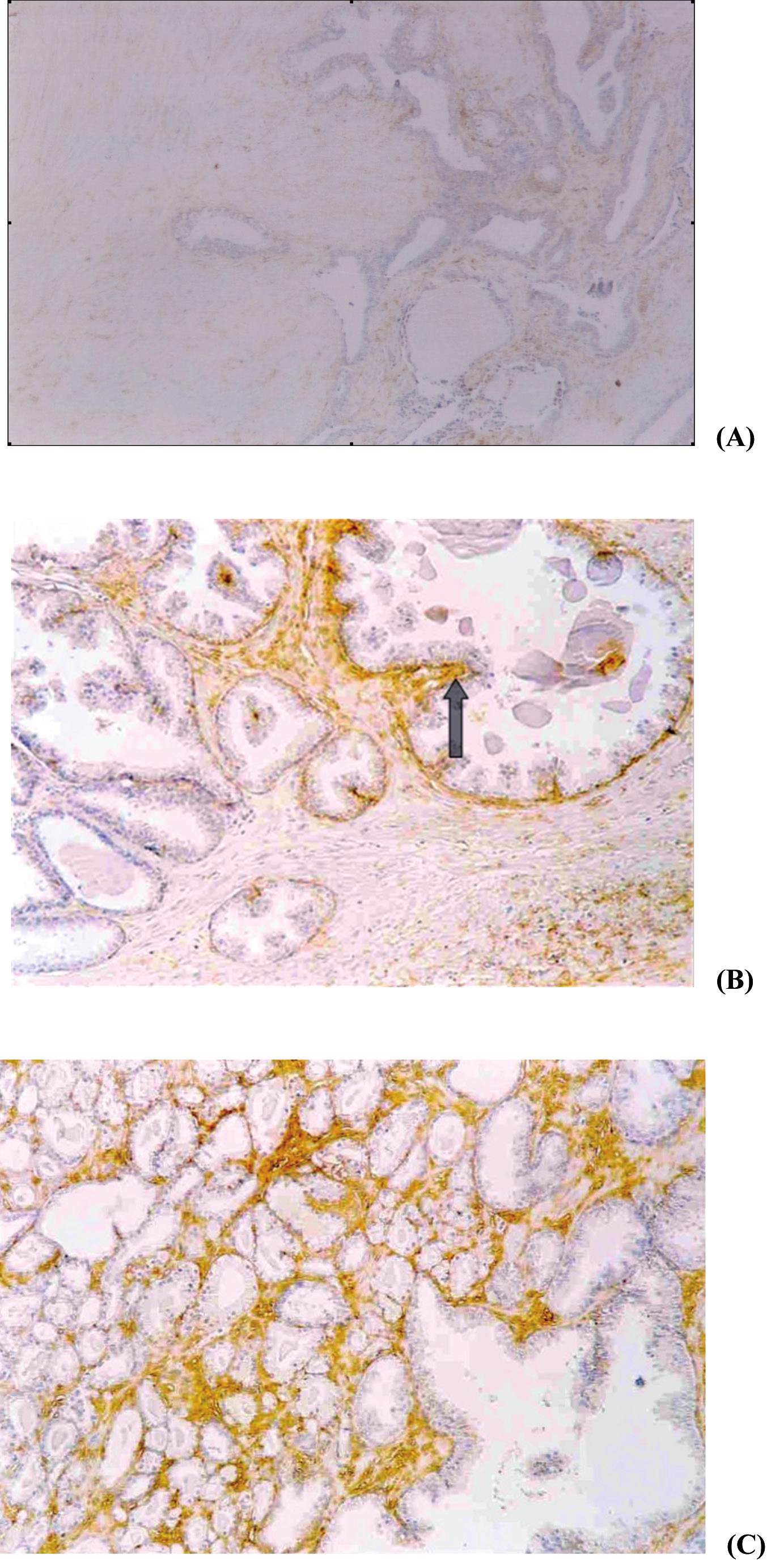 Ηyaluronic Acid in Prostate Cancer 3 HABP, Seikagaku Corporation, Tokyo, Japan). The concentration of the protein was 2.5 μg/ml, diluted in PBS, and the incubation was carried out overnight at 4oC.