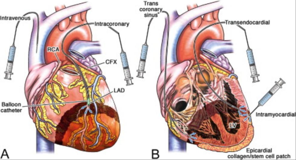 From: 10 Years of Intracoronary and Intramyocardial Bone Marrow Stem Cell Therapy of the Heart: From the Methodological Origin to Clinical Practice J Am Coll Cardiol. 2011;58(11):1095-1104. doi:10.