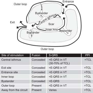 A. Επανείσοδος σχετιζόµενη µε ουλή (scar-related reentry):