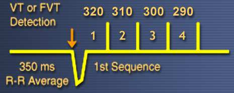 Π.χ. 91% - 4 pulses Ramp pacing Αλληλουχία βηµατοδοτικών