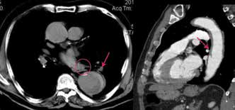 21 Η μέθοδος εκλογής στη διάγνωση του ΔΤΕ είναι η αξονική τομογραφία με σκιαγραφικό όπου απεικονίζεται ως ένας κρατήρας του αορτικού τοιχώματος ή ως ένας προπίπτων σάκος έξω από τον αυλό.