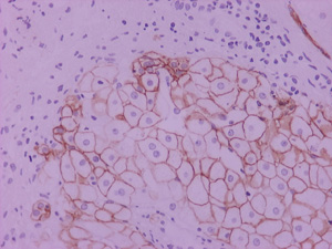 περιορισμένο αριθμό κυττάρων, σε 1 βιοψία μέτριο αριθμό και σε 7 βιοψίες μεγάλο αριθμό. Εικόνα 14: Ανοσοϊστοχημική χρώση για τον παράγοντα EpCAM σε περίπτωση NAFLD με έντονη ίνωση.