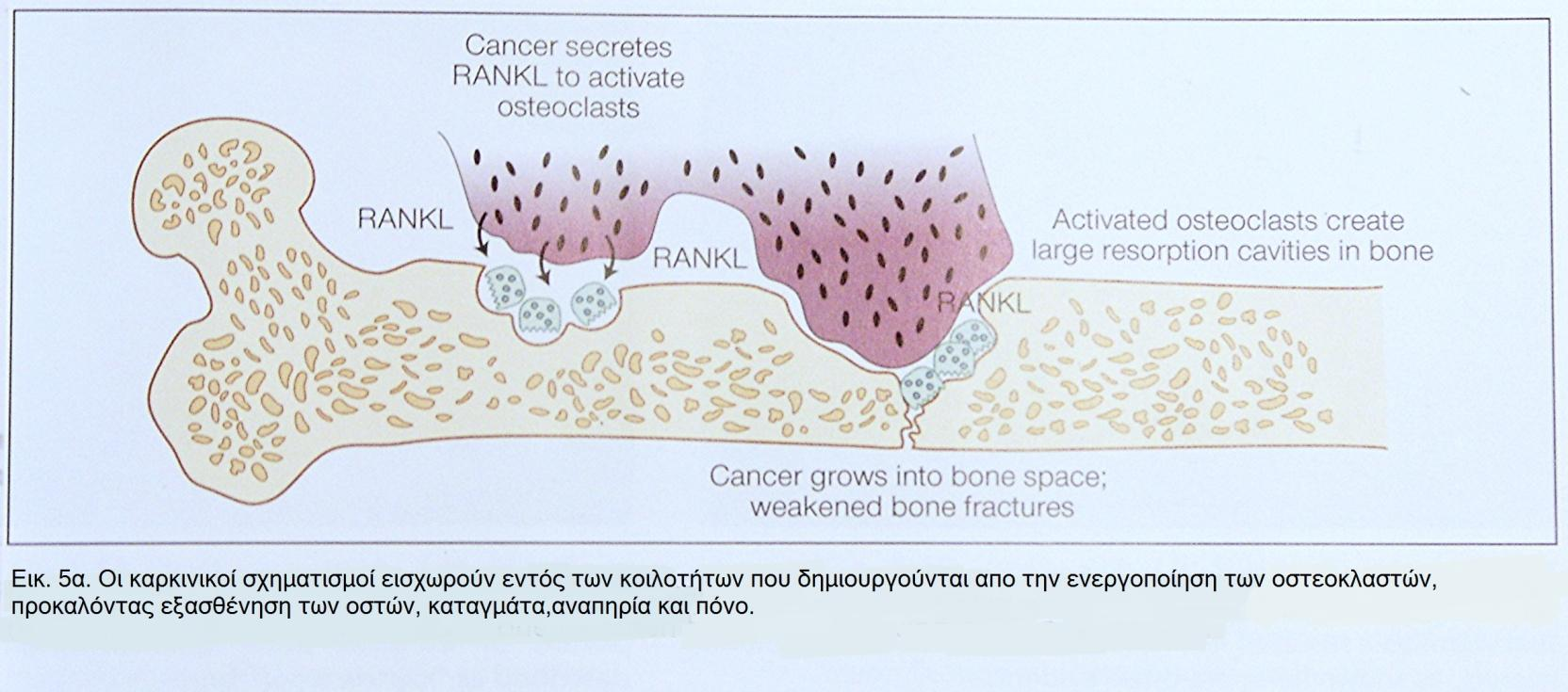 14 της έκλυσης από τα καρκινικά κύτταρα της πρωτεΐνης RANKL και άλλων παρόμοιων ενεργοποιητών