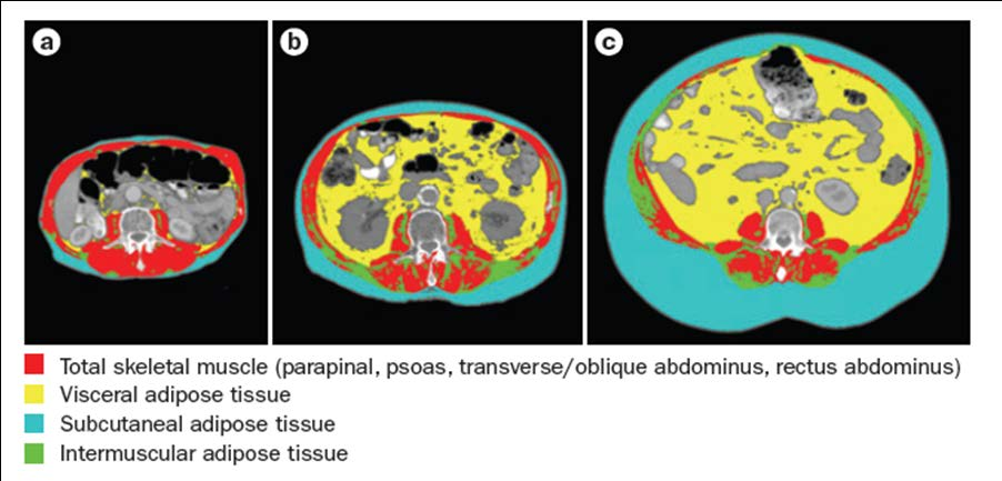 Εισαγωγή Sarcopenic Obesity BMI = 17 kg/m 2 BMI = 25 kg/m