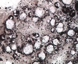 inclusions (α), considerable amount of lipid material (β, γ - arrows) and increased