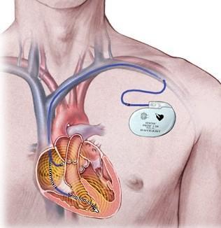 Κεφάλαιο 1: Εισαγωγή Σχ. 1.2 Καρδιακός βηματοδότης. Η τοποθέτηση στο ανθρώπινο σώμα γίνεται μέσω χειρουργικής επέμβασης.