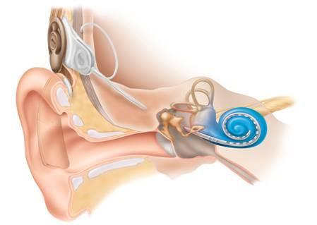 Κεφάλαιο 1: Εισαγωγή Εμφυτεύματα κοχλία (cochlear implants) Μια εξίσου διαδεδομένη εμφυτεύσιμη διάταξη αποτελεί το εμφύτευμα κοχλία.