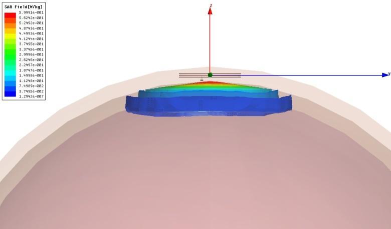 Κεφάλαιο 4:Πρωτότυπη μικροσκοπική εμφυτεύσιμη κεραία MedRadio μεγάλου εύρους ζώνης Σχ. 4.31 Κατανομή SAR για 10g ιστού. Η Μέγιστη τιμή του δείκτη SAR για 1g ιστού είναι 513.