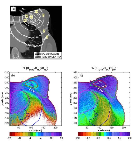 Εικόνα B.5.1. Σύγκριση TG-43 και εξατομικευμένης (Monte Carlo) δοσιμετρίας στην κεντρική εγκάρσια τομή του PTV για έναν αντιπροσωπευτικό ασθενή.