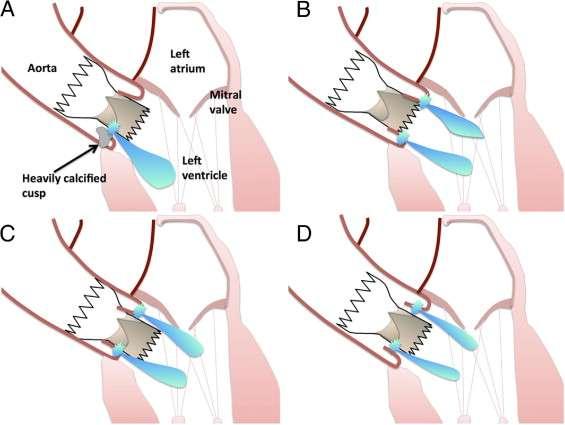 Paravalvular Leak Calcifications of the cusps of the native valve Too shallow valve