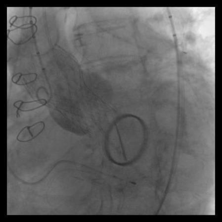 Implantation level according to non-coronary cusp pigtail Metallic mitral valve LVOT adjunction level The CoreValve prosthesis is in optimal position, in respect 1.